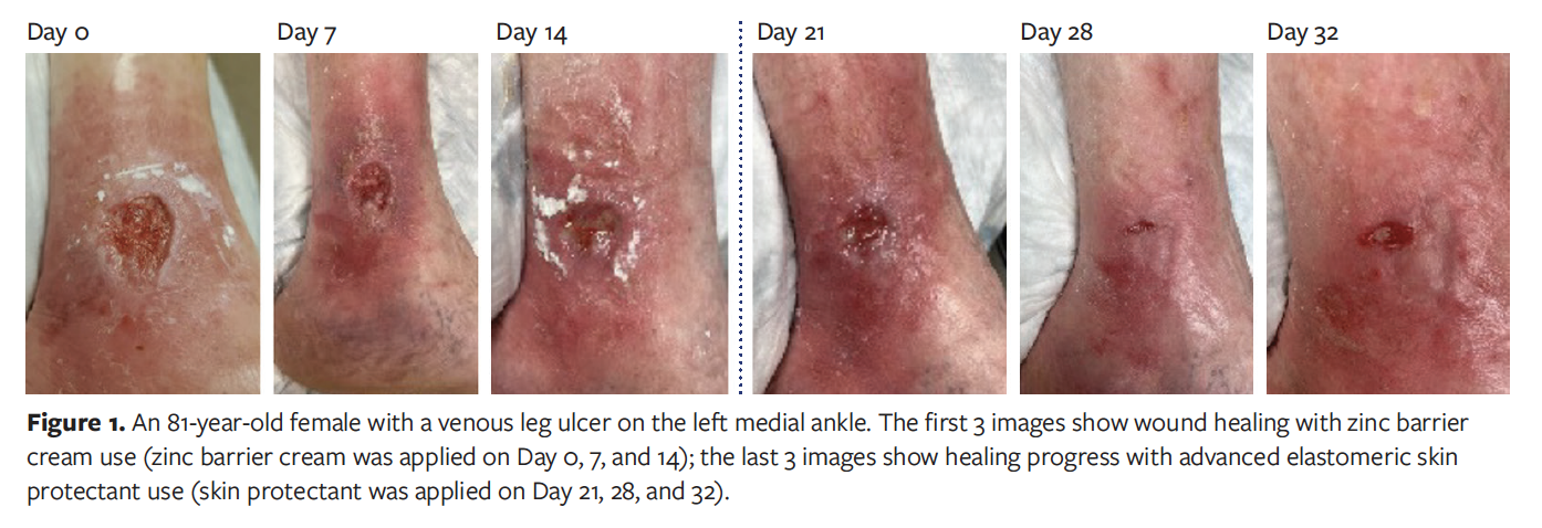 Use of Advanced Elastomeric Skin Protectant on Venous Leg Ulcer